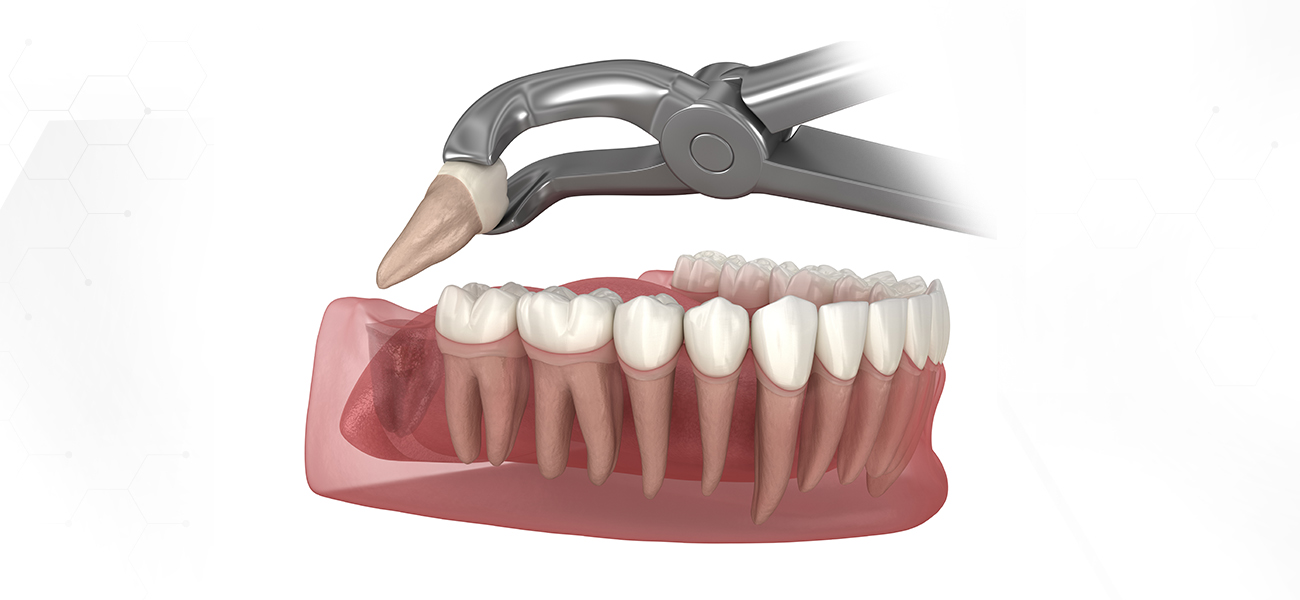 서울수치과 사랑니발치
