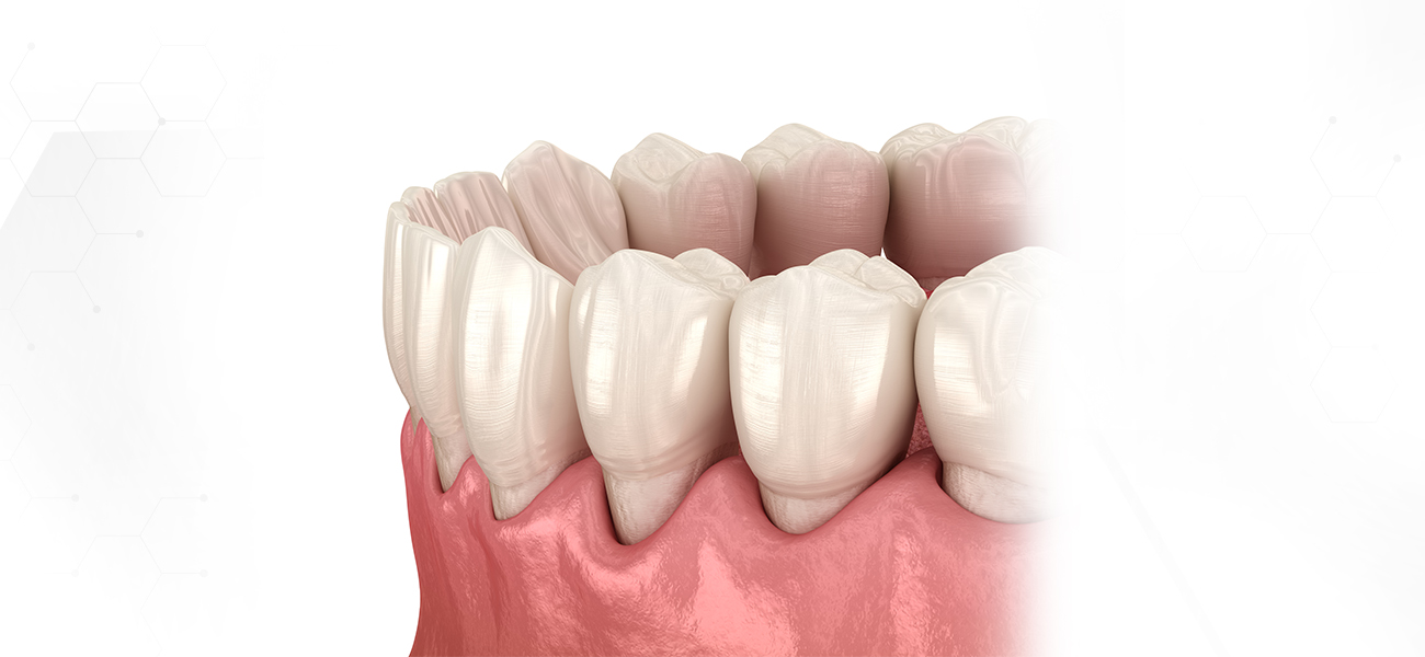 서울수치과 잇몸치료 스케일링 스케일링건강보험 치주치료 잇몸수술 치주수술