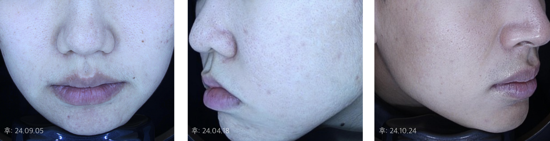 복합성 여드름 흉터, 디렉터에서 해결