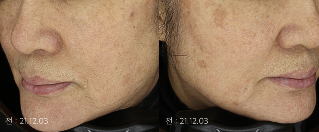 검버섯, 잡티, 흑자, 홍조 혼재된 시니어