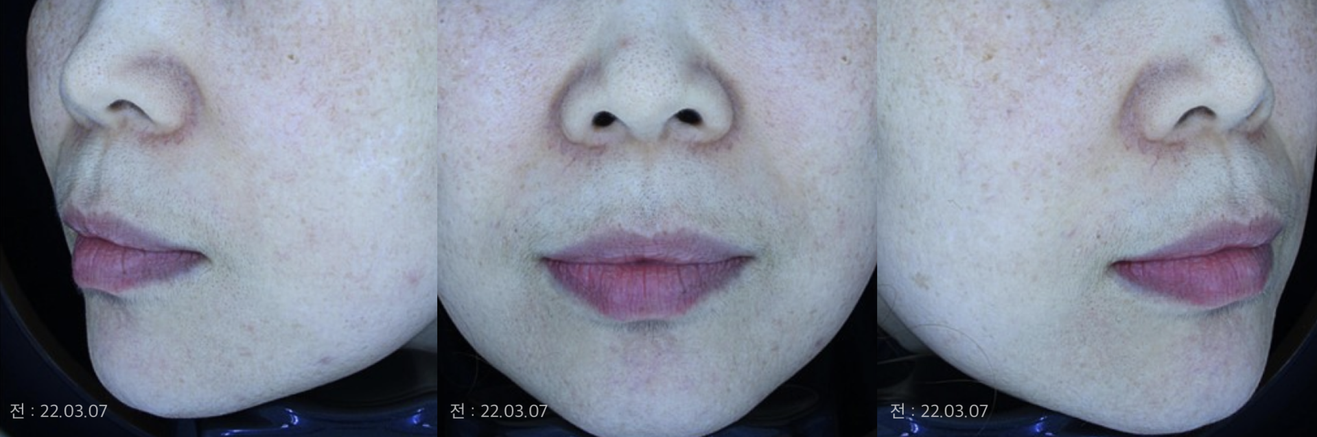 양볼에 기미와 잡티 혼재, 안면홍조까지 복합적 색소병변