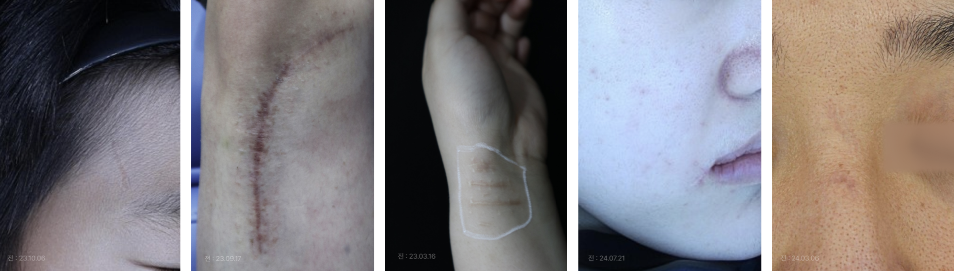 흉터의 종류만큼 치료 방법도 달라져야 합니다.