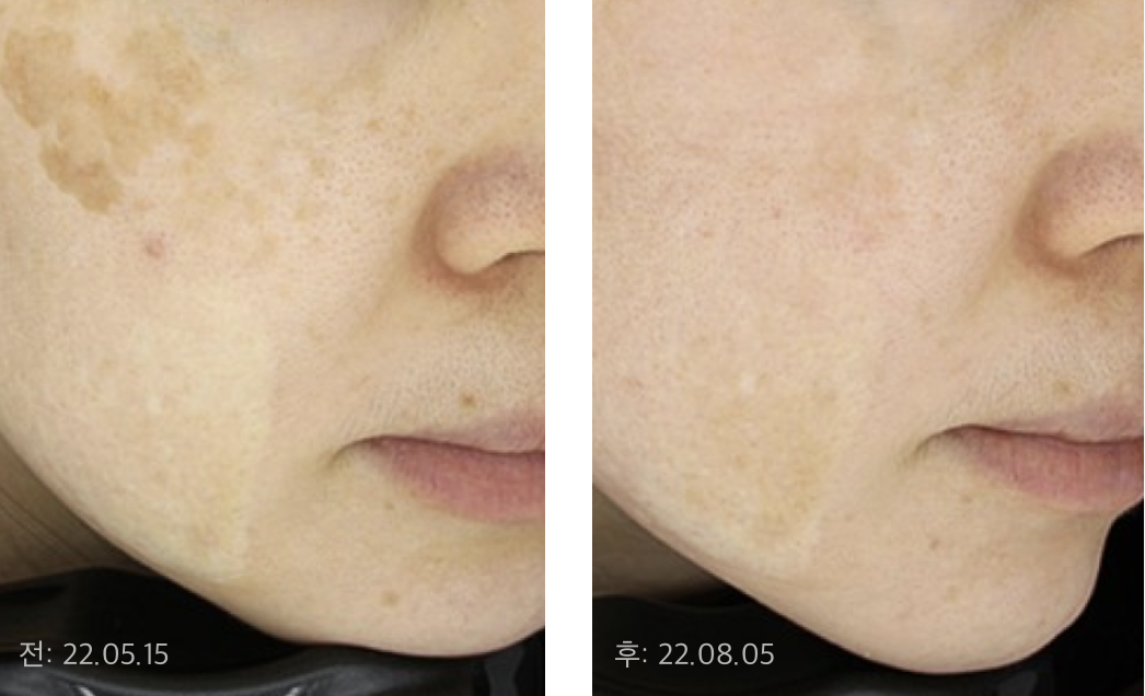 치료가 어려운 거대 흑자, 기미, 잡티가 혼재된 경우