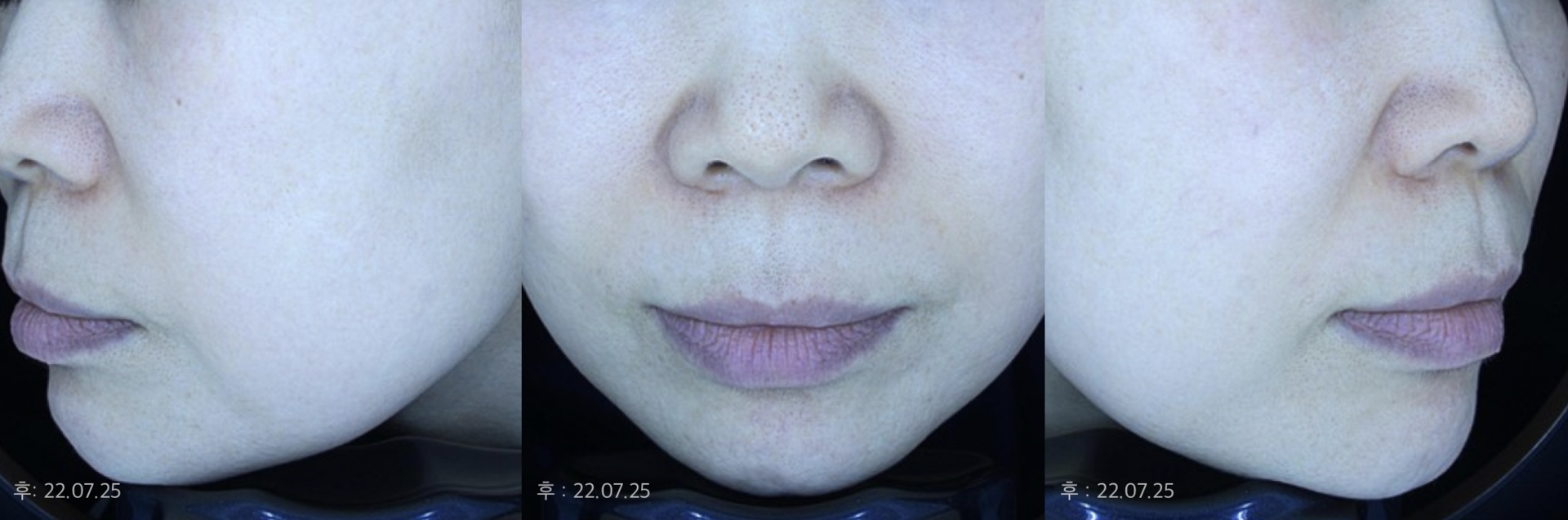 3~4가지 색소치료 레이저와 홍조 치료 레이저를 조합, 적정 간격으로 세밀하게 강도 조정 진행