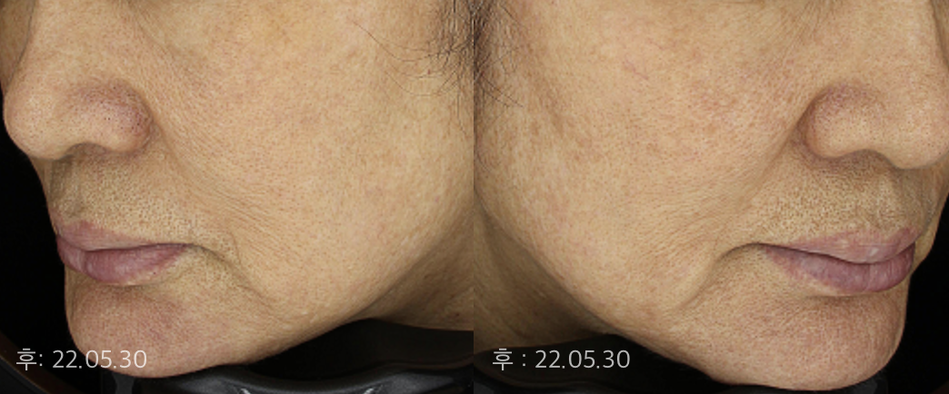 색소별 맞춤치료와 진피층 재생치료로  맑은 피부톤과 탄력 개선! 더 젊어보이는 효과