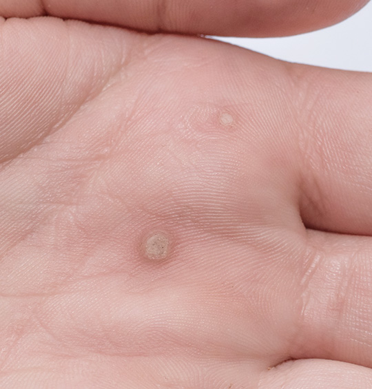 티눈, 사마귀 치료에 대한 설명