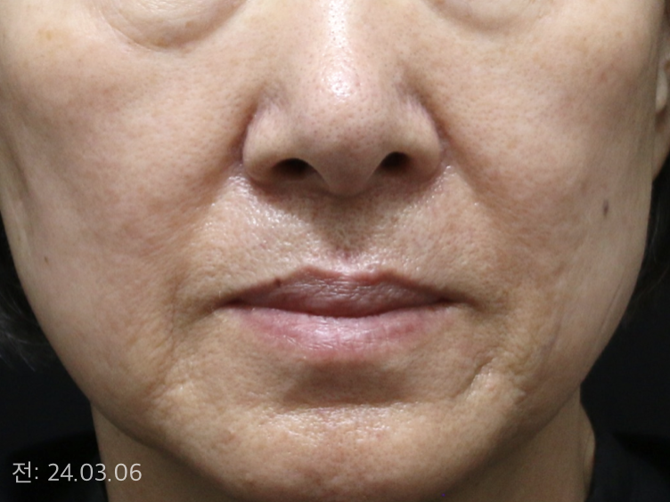 얼굴 주름과 피부 처짐,  늘어지고 불룩해진 눈밑(60대)