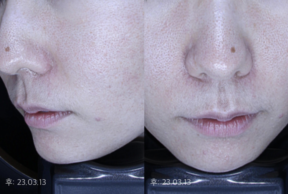  후 23.03.13 (퍼스널 디렉팅+약물+혈관레이저+고주파+ 재생치료 2차 치료 후 5개월 경과)