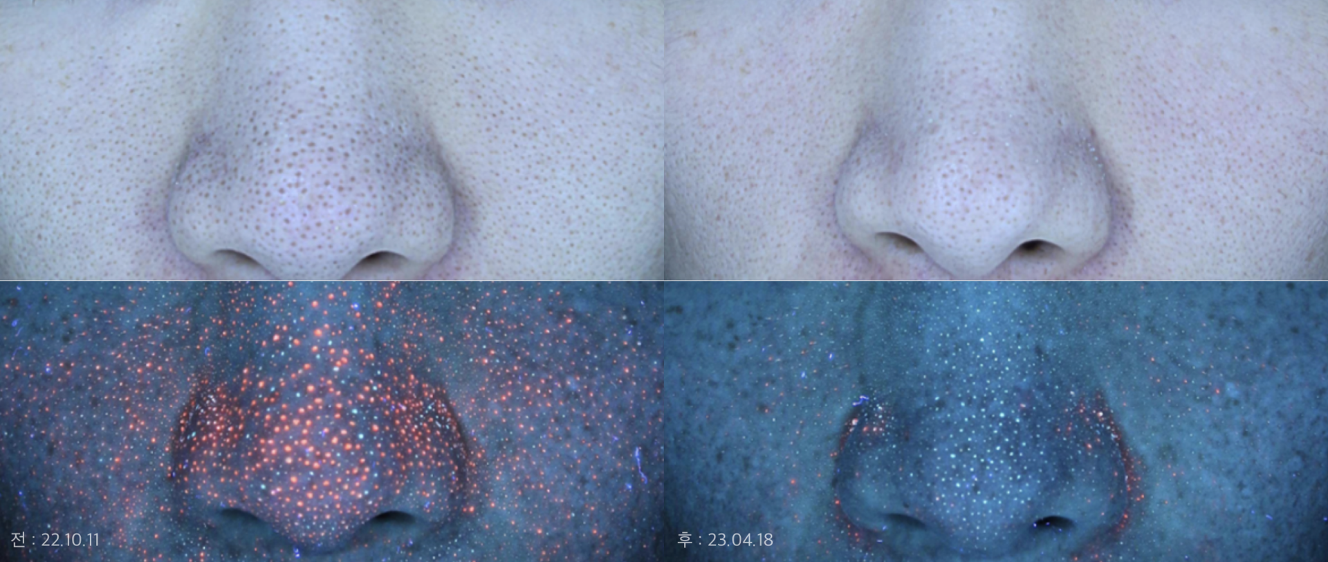 과거 모공 축소 시술 20회 받은 분 → 