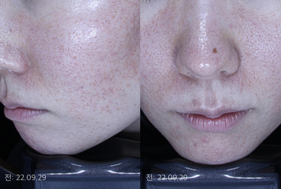 전 22.09.29 (여드름과 흉터로 타병원의  레이저시술, 약, 관리 경험. 홍조·트러블 지속)