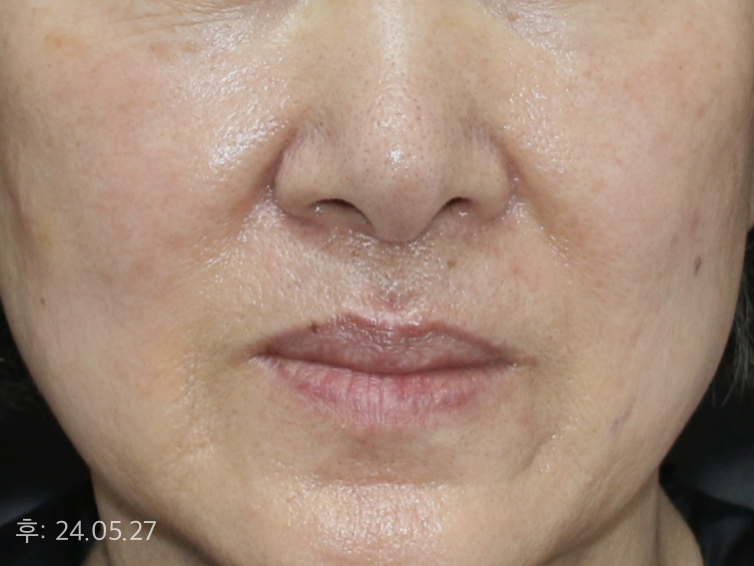 울쎄라와 레디어스 주입 시술로 탄력, 주름, 눈밑 고랑 모두 개선