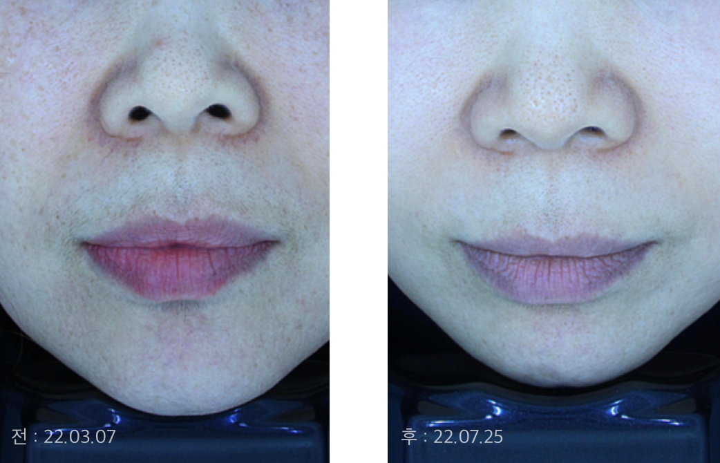 양볼에 기미, 잡티,안면홍조 동반된 상태