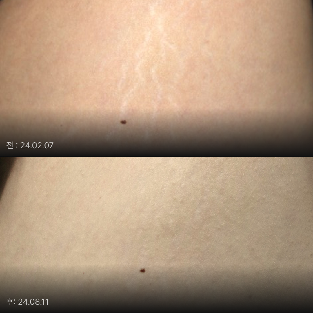 흉터학회 발표 논문에도 소개된 큐어젯을 이용한 튼살흉터 치료 예(이지민 대표원장)