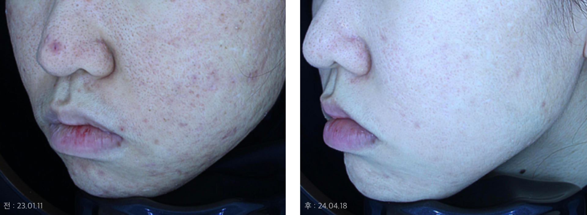 안면홍조와 흉터 동반된 상태로 내원 → 디렉터의 홍조·흉터 복합치료와 재생치료