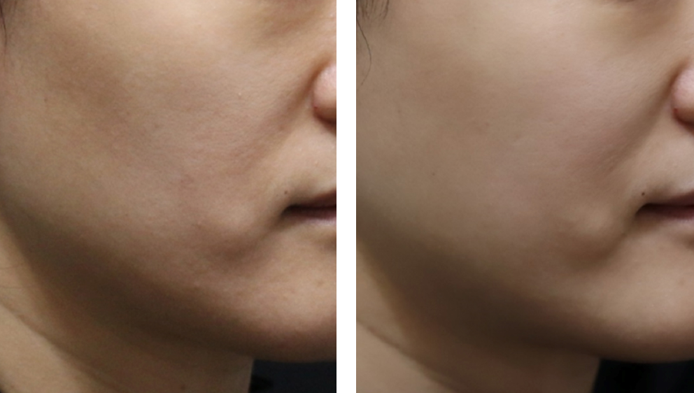 전 (24.01.25) / 후 (24.06.15)