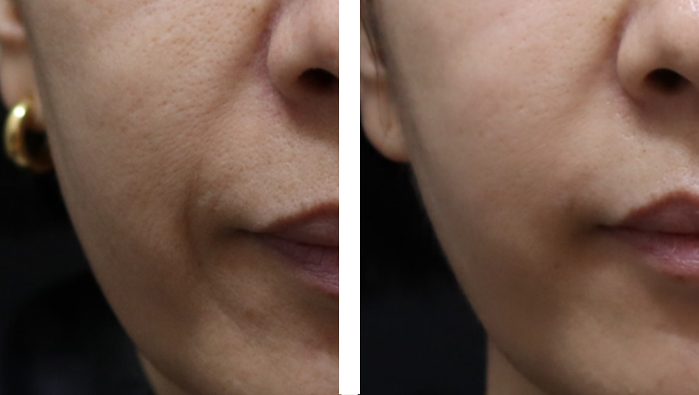 전 (24.02.10) / 후 (24.06.14)