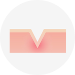 아이스픽 흉터 설명