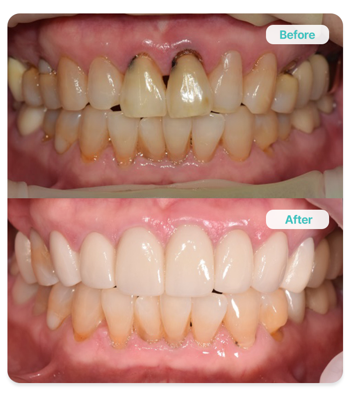 <p><span style="font-size: 26px;"><span style="color: rgb(63, 193, 190);"><strong>02 </strong></span><span style="color: rgb(151, 151, 151);"><strong>동안 비앙쉬 (82세)</strong></span></span></p>