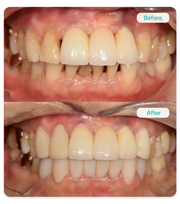 원데이 비앙쉬 72세<br><br>