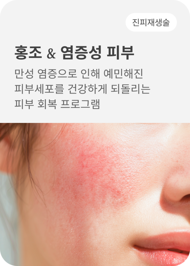 청담 끌레어의원 홍조 염증성 피부 시술 이미지