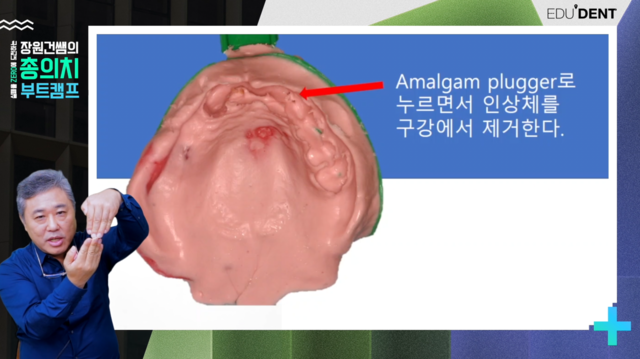 Immediate Complete Denture 과정 & 난감한 상황들