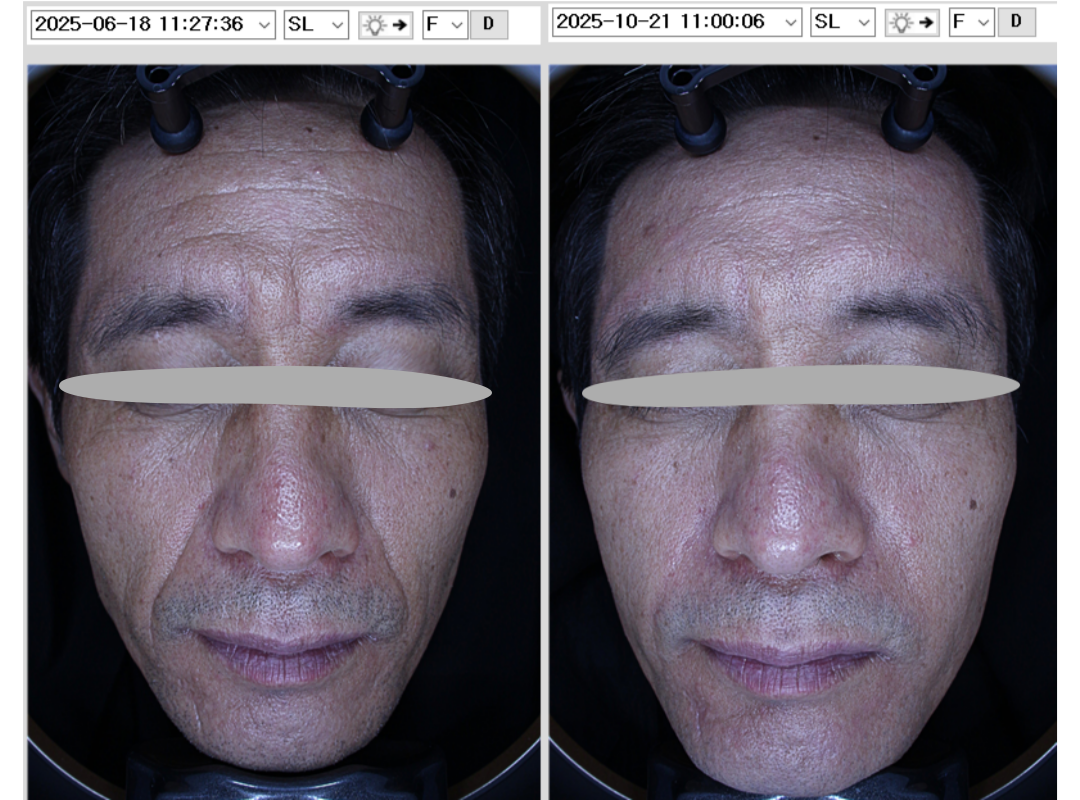 쥬브젠시술전후 실제 시술하신고객님의 동의를 받았으며 별도 보정이 들어가지 않은 동일한 조건에서 촬영한 사진입니다. 해당시술은 멍, 염증, 붓기등의 부작용이 있을 수 있습니다. 