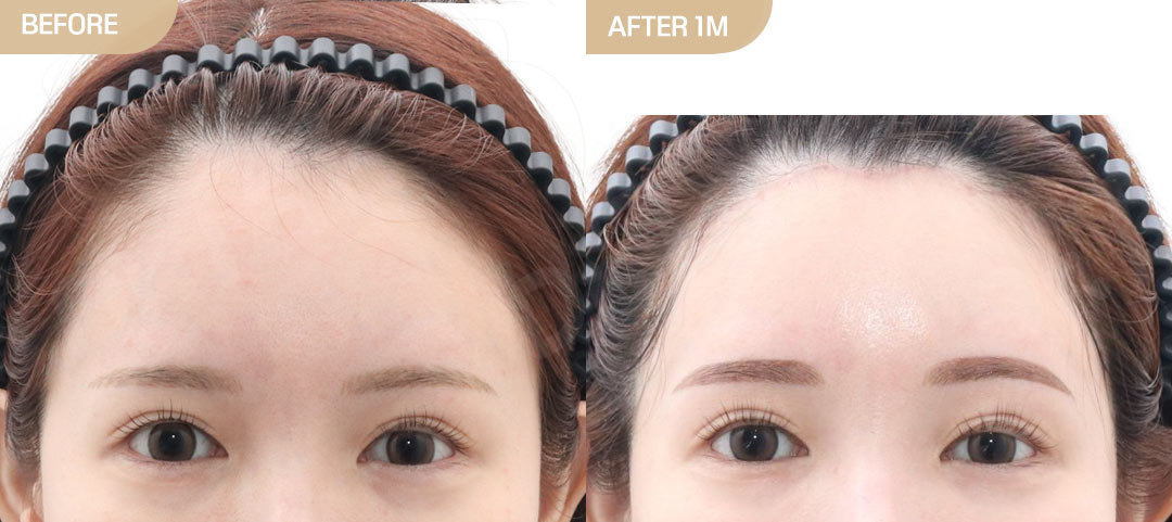 Large Forehead Surgery in Korea: Real Results, Costs & Before & After ...