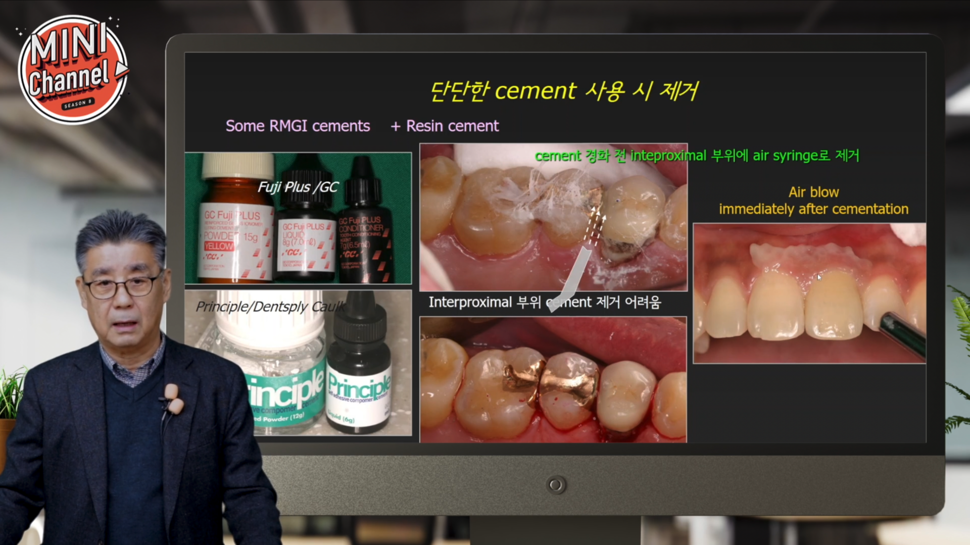 자연치/임플란트 수복물 Cementation 고려사항 썸네일