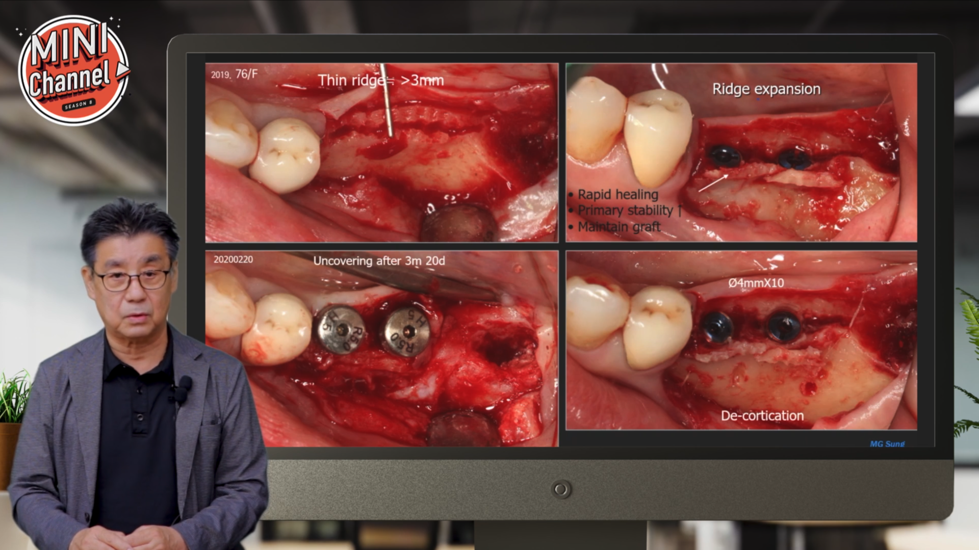 Zirconia 수복물 Longevity 썸네일