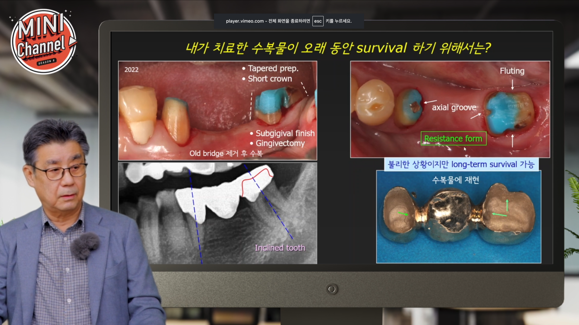 Zirconia 내면처리 썸네일