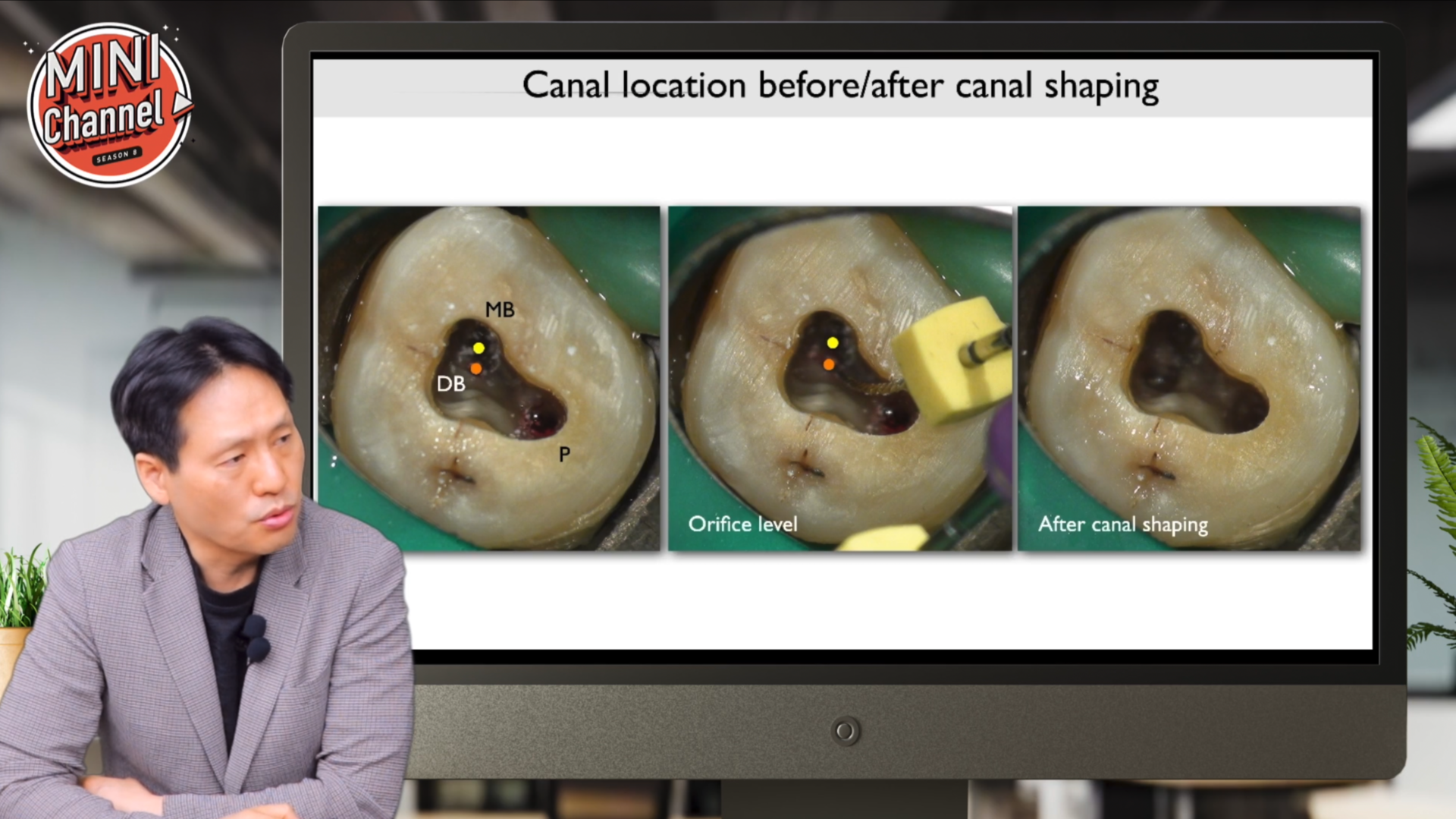엔도 실전 케이스 리뷰 Now!! Cases presentation! (2) 썸네일