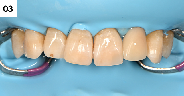 치아 옆면과 모서리 레진 빌드업 