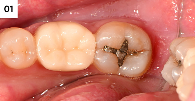 아말감 주변으로 치아에 금이 가 있음