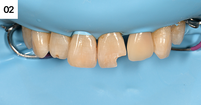 기존 레진 제거