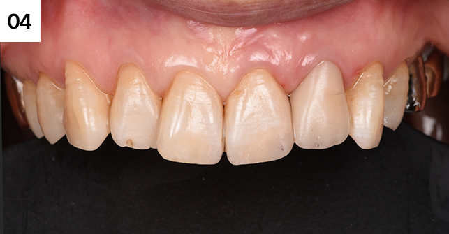 치아 형태를 다듬고 마무리 