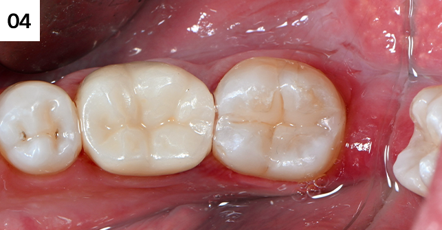 레진빌드업으로 치아복원