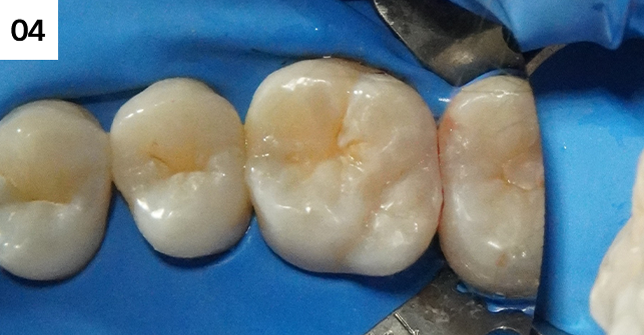 레진빌드업으로 치아 복원
