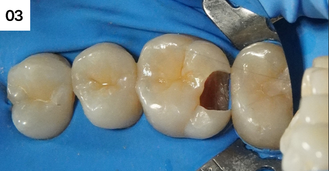 충치제거 완료. 신경치료를 하지 않고 최소한의 치질 삭제