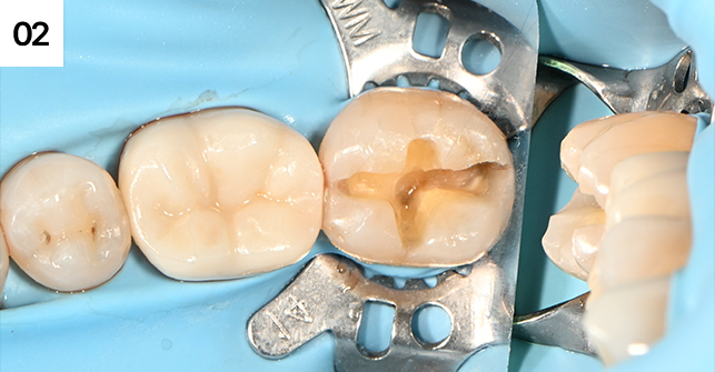 2차충치 및 금을  최대한 제거