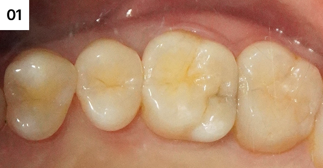 내부에 깊은 충치가 있음