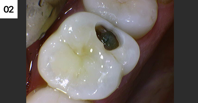 충치 제거중. 충치가 깊고 넓으며 크랙도 보임