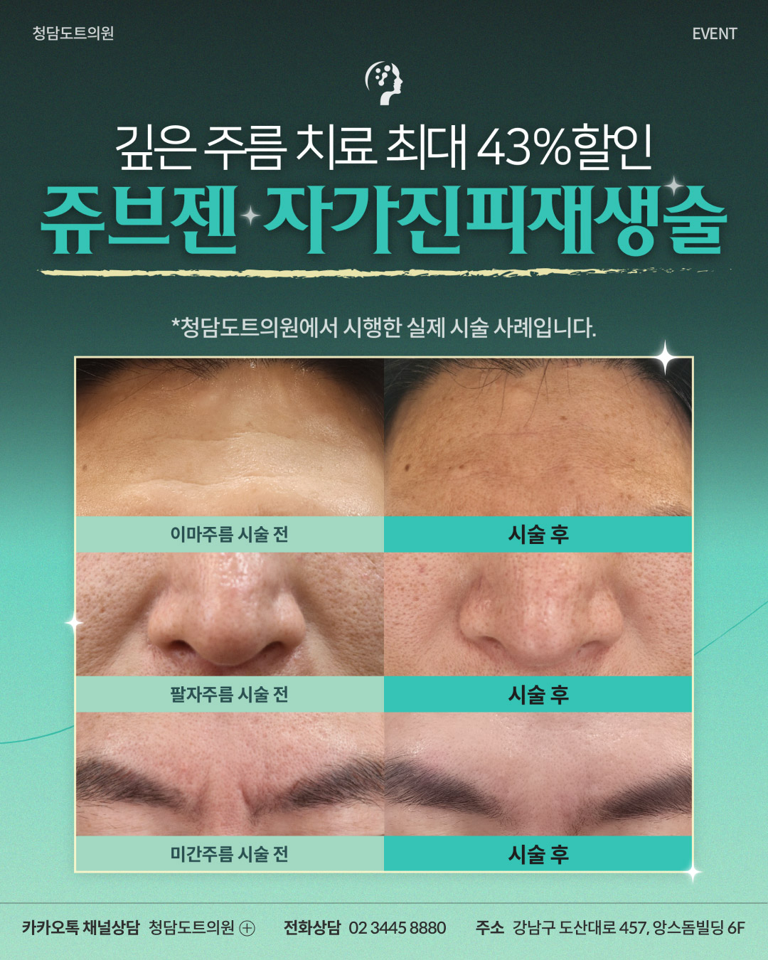 쥬브젠 자가진피 재생술 이벤트