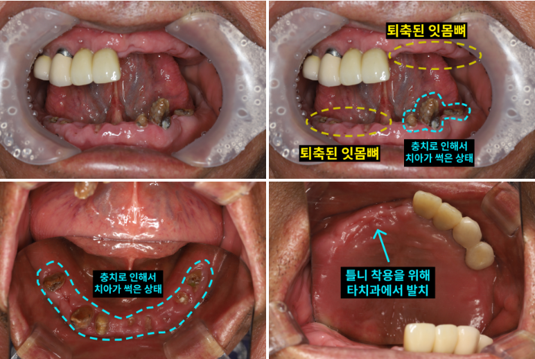 처음 내원 시 구강 내부 사진, 70대 남성 (2025.9 촬영)