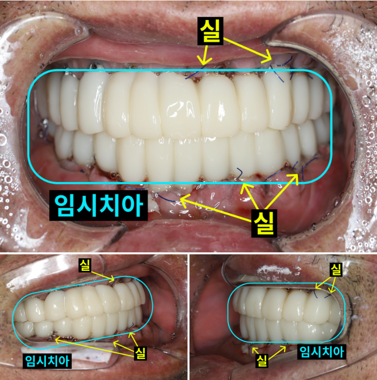 수술  2일 후 임시치아, 70대 남성 (2025.9 촬영)