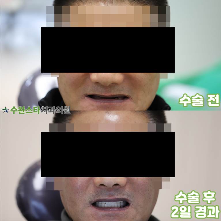 수술 전 / 수술 후 2일 경과, 60대 남성 (2025.2 촬영)