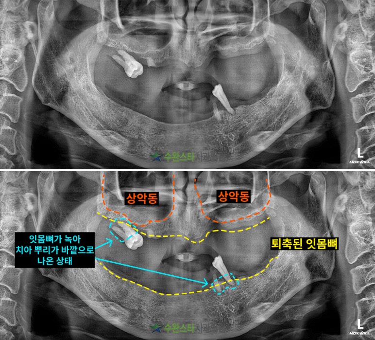 처음 내원 시 파노라마, 60대 남성 (2025.2 촬영) 