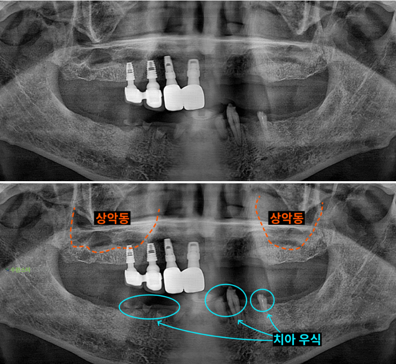 처음 내원 시 파노라마, 70대 남성 (2025.9 촬영)