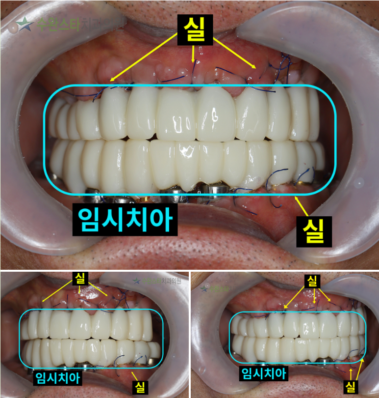  수술 2일 후 임시치아, 60대 남성 (2025.2 촬영)