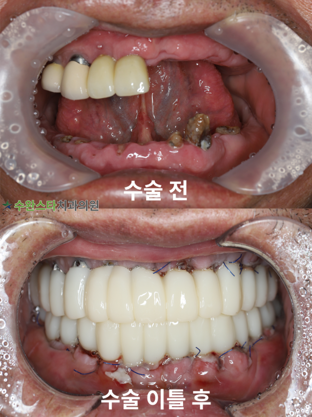수술 전 / 수술 후 2일 구강 내부 70대 남성 (2025.9 촬영)