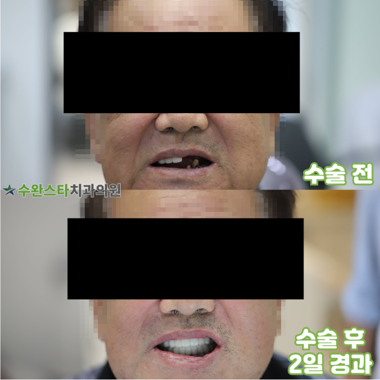 수술 전 / 수술 후 2일 경과, 70대 남성 (2025.9 촬영)